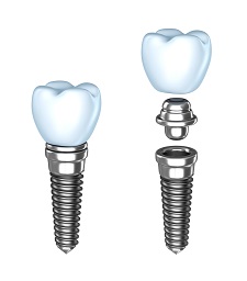 Dental Implants | North York Toronto, ON | Astra Dental